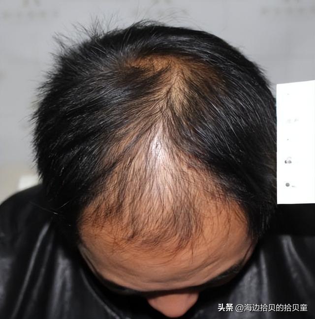 好？育发液什么牌子最有效果？开元棋牌日本生发液哪个牌子最(图4)